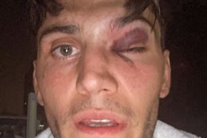 津门虎外援萨尔瓦多晒眼部受伤照：会以更强大的姿态归来